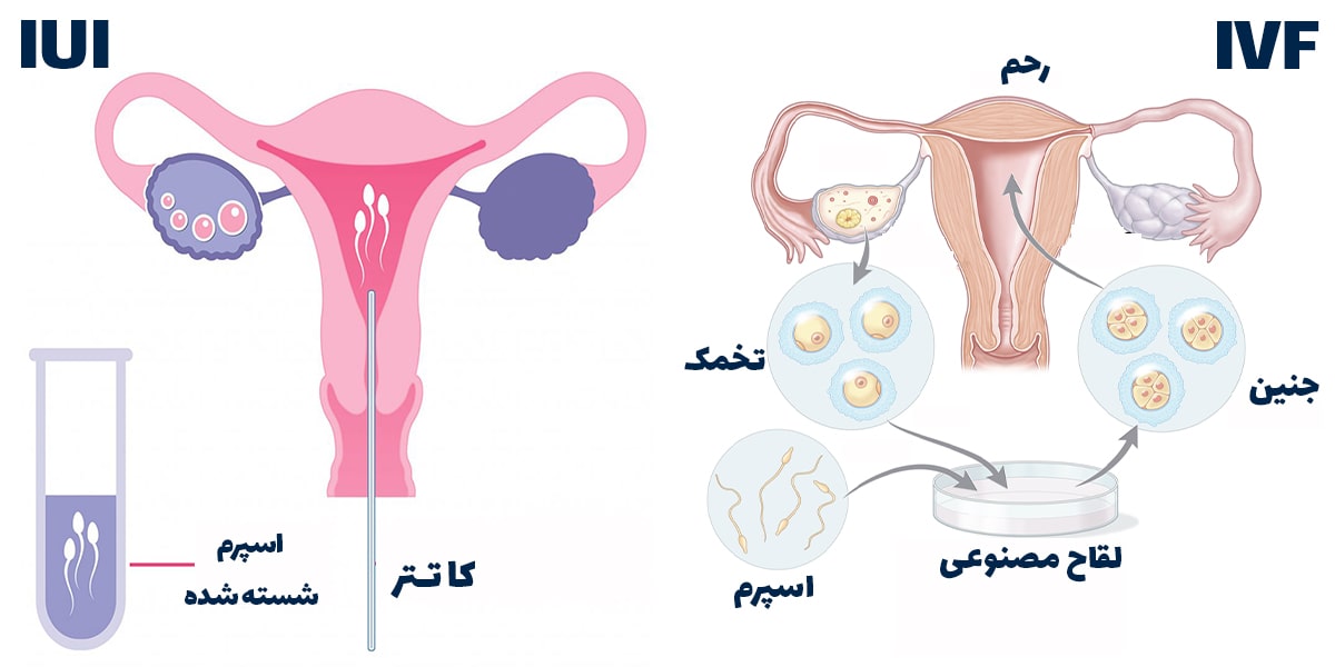 تعیین جنسیت قبل از بارداری